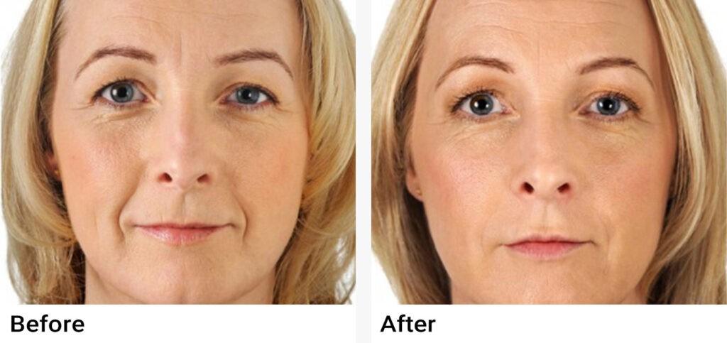 Radiesse Before & After Examples