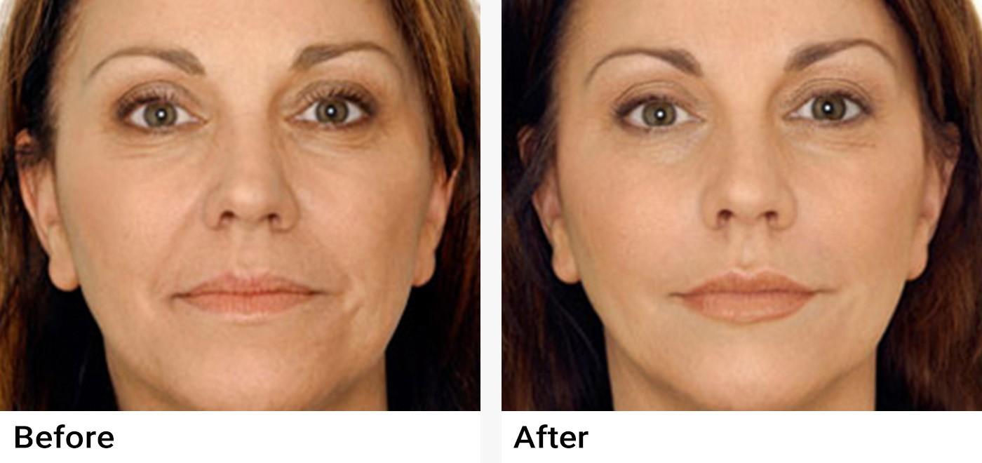 Restylane Before & After Examples