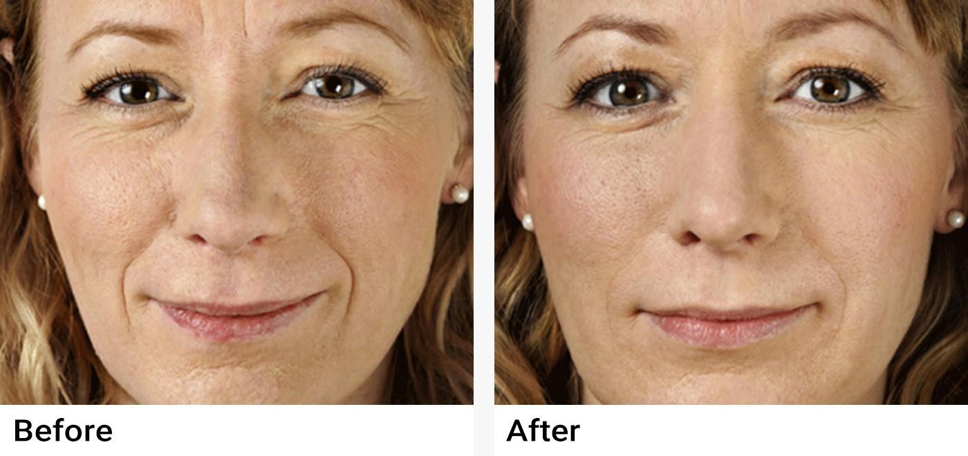 Restylane Before & After Examples