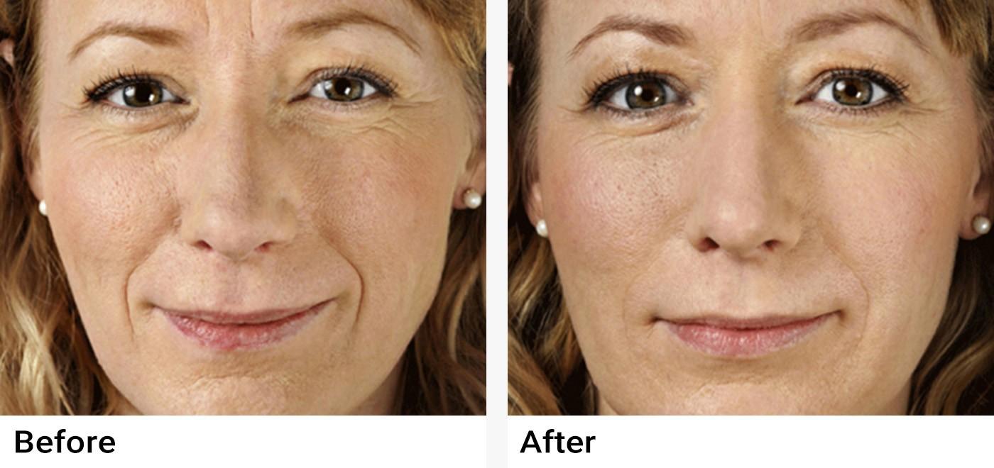 Restylane Before & After Examples