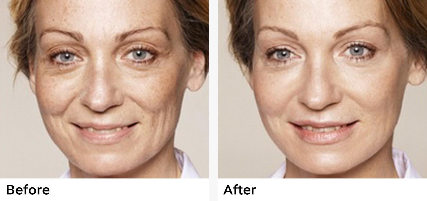 Restylane Before & After Examples