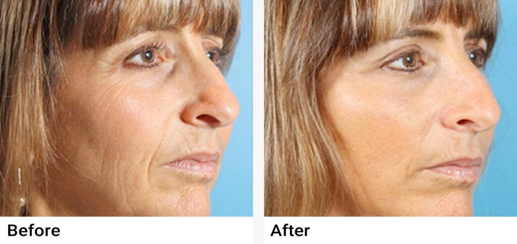 Restylane Before & After Examples