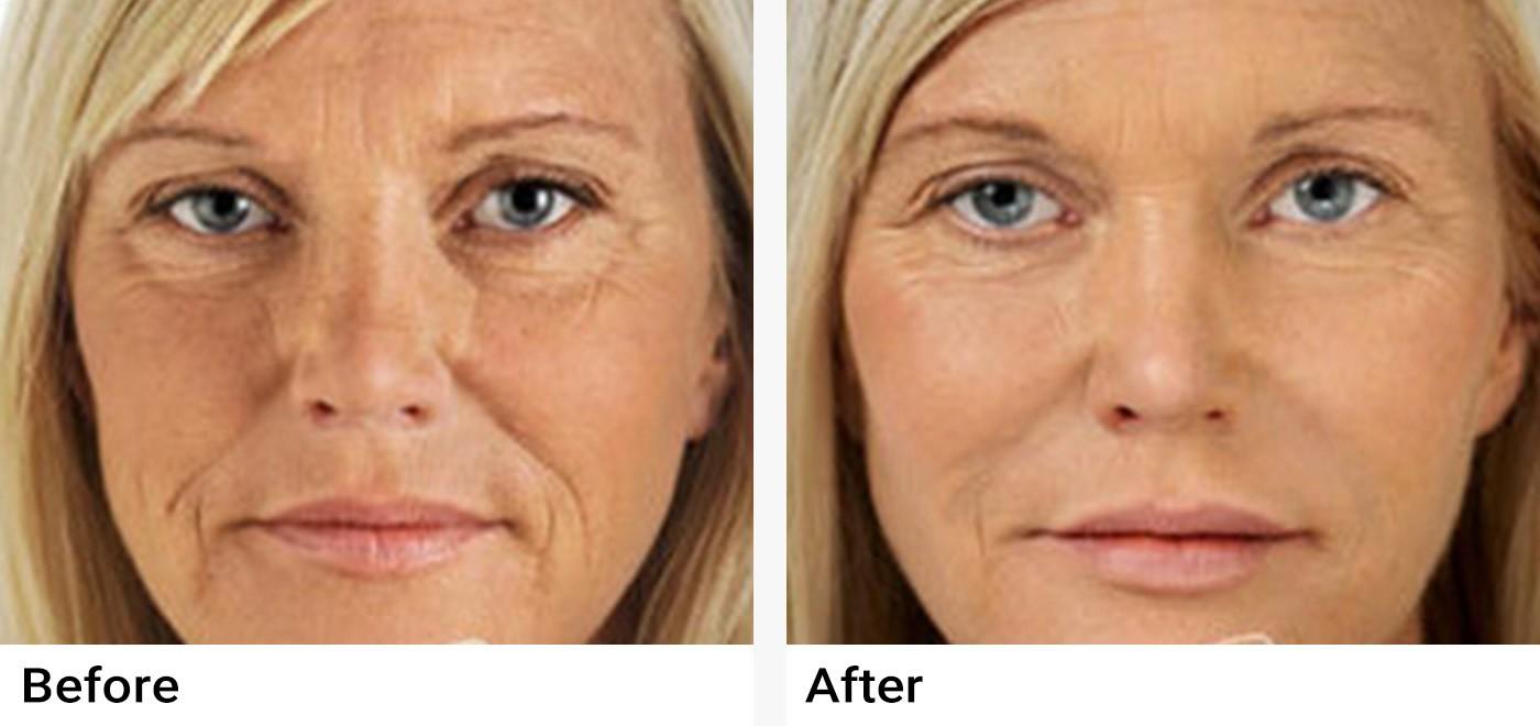 Restylane Before & After Examples