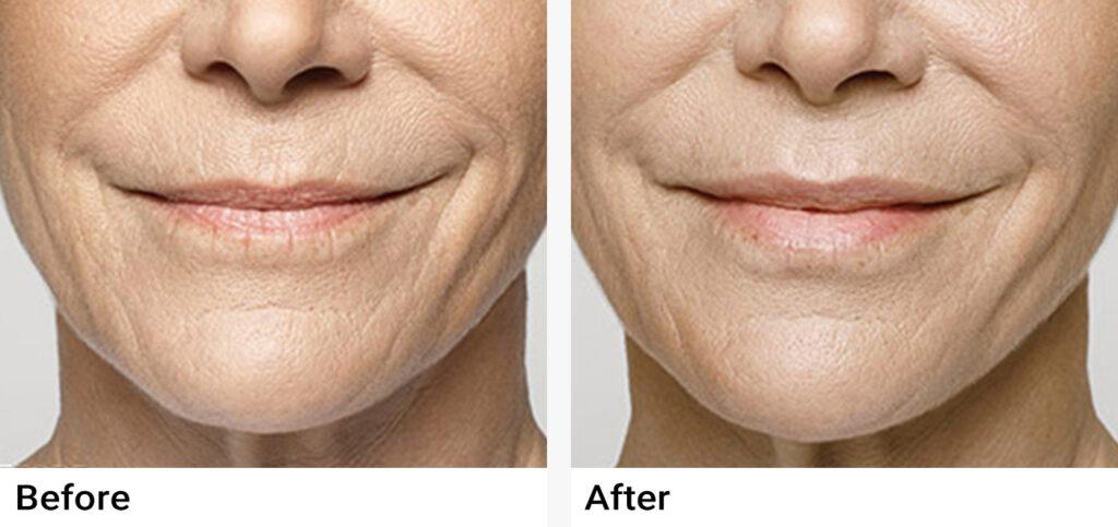 Restylane Before & After Examples