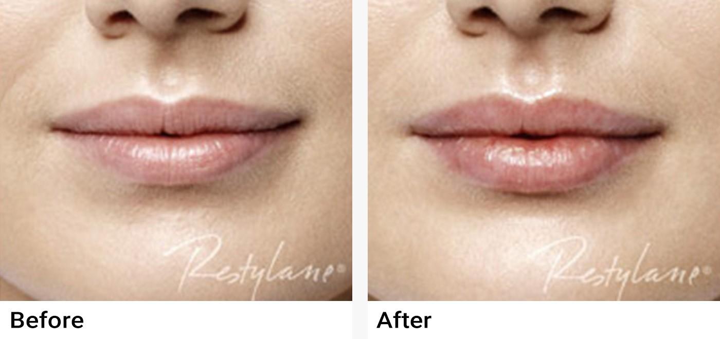 Restylane Before & After Examples