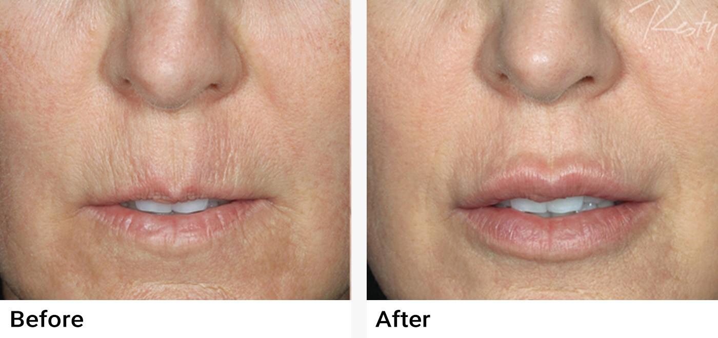 Restylane Before & After Examples