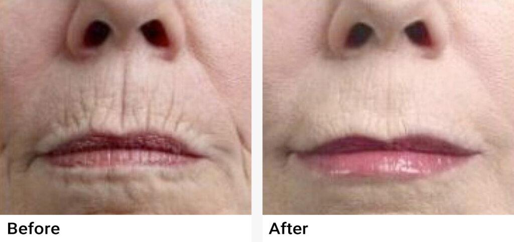 Restylane Before & After Examples