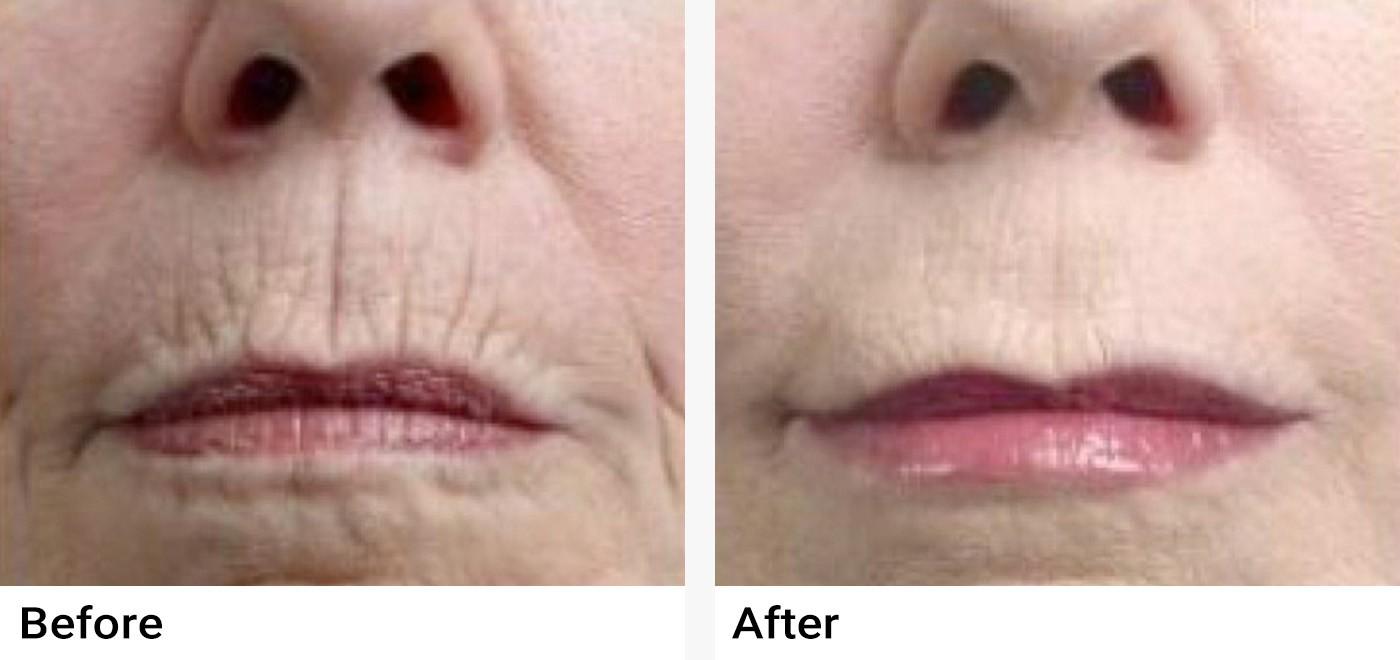 Restylane Before & After Examples