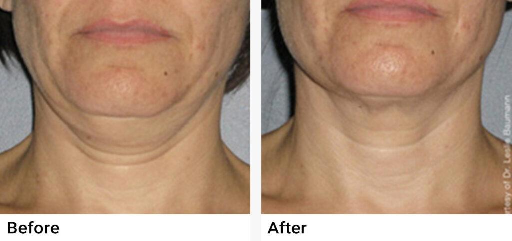 Ultherapy® Before & After Examples