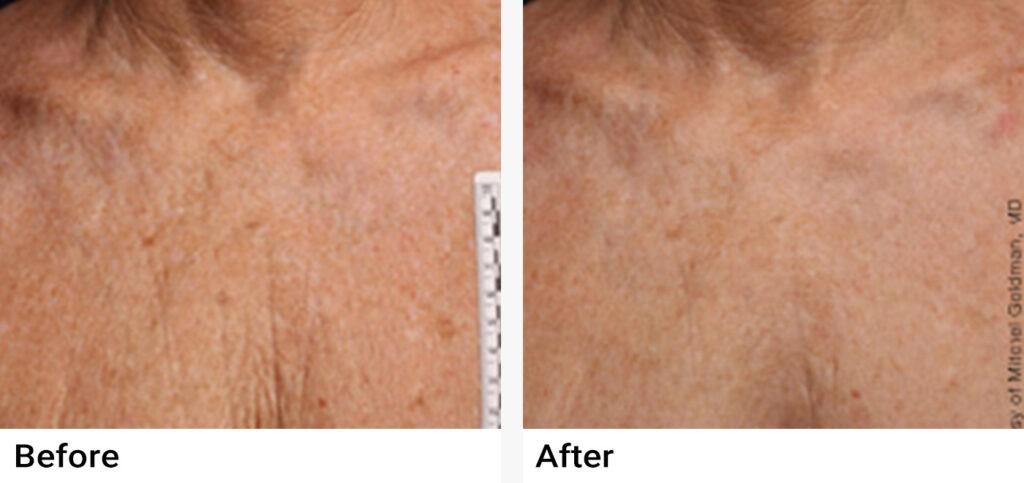 Ultherapy® Before & After Examples