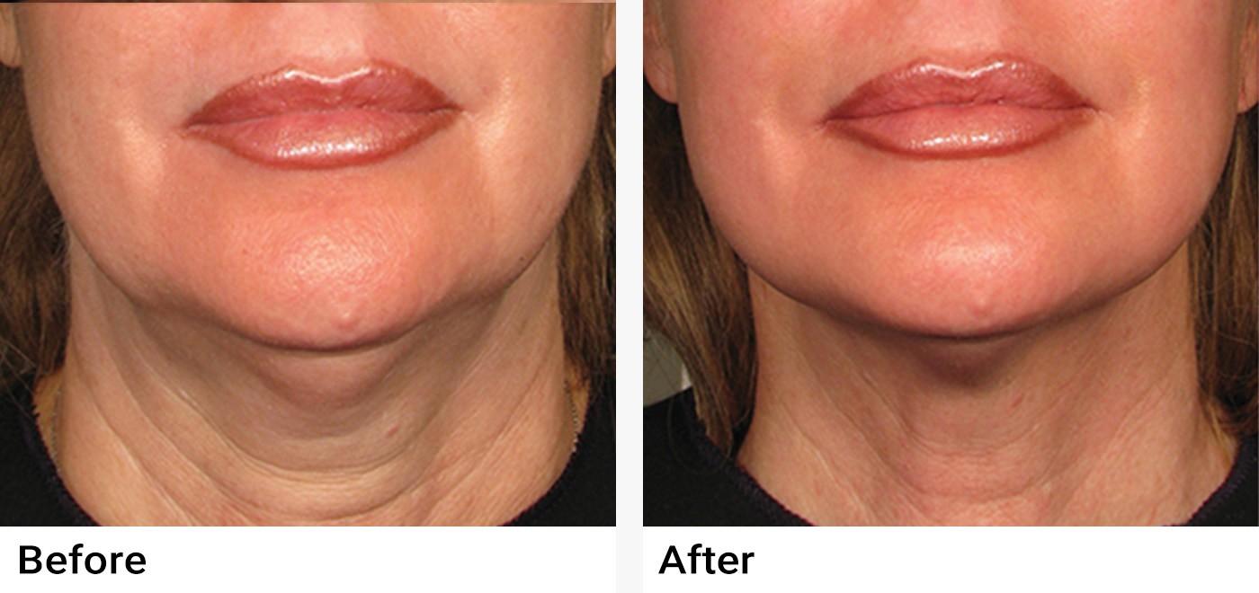 Ultherapy® Before & After Examples