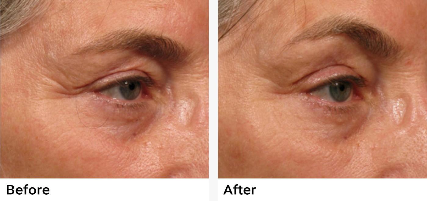 Ultherapy® Before & After Examples