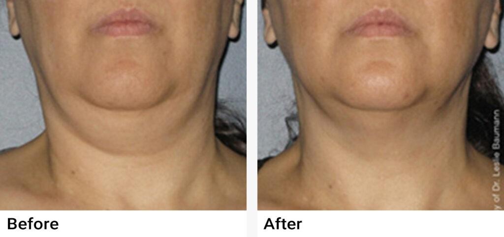 Ultherapy® Before & After Examples