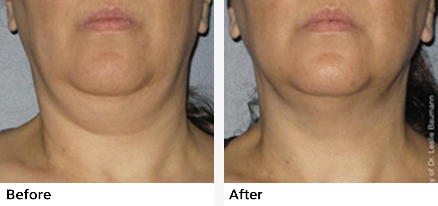 Ultherapy® Before & After Examples