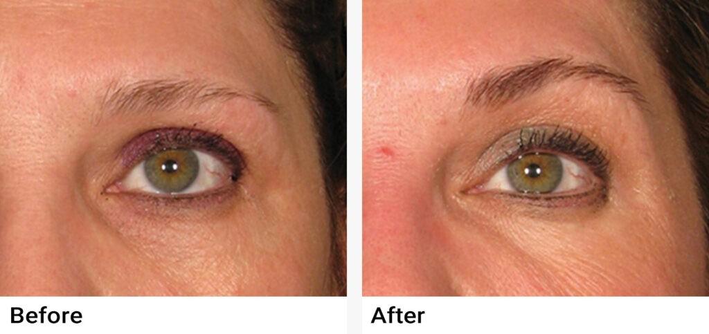 Ultherapy® Before & After Examples