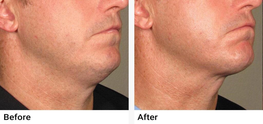 Ultherapy® Before & After Examples