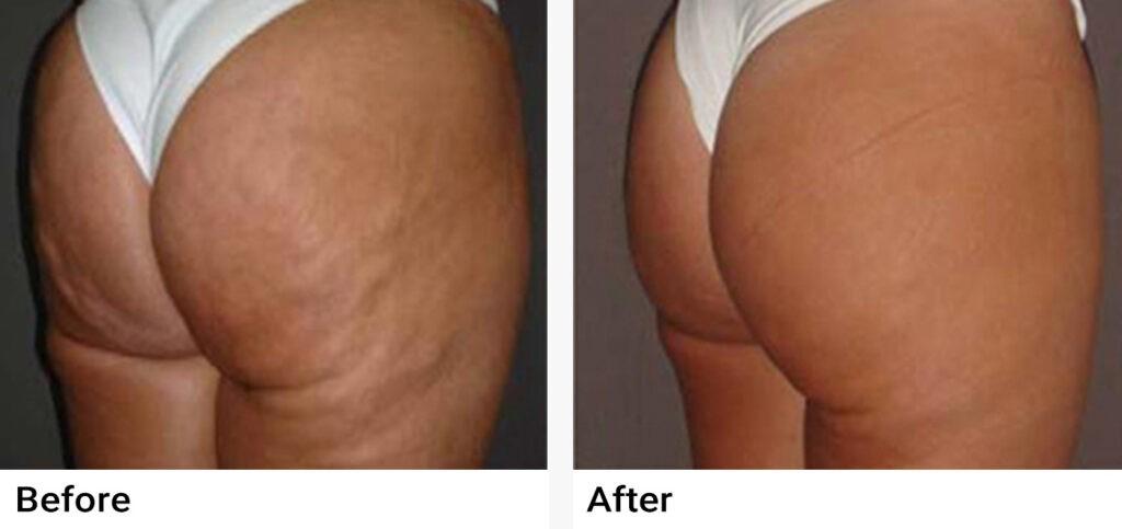 VASERShape Before & After Examples