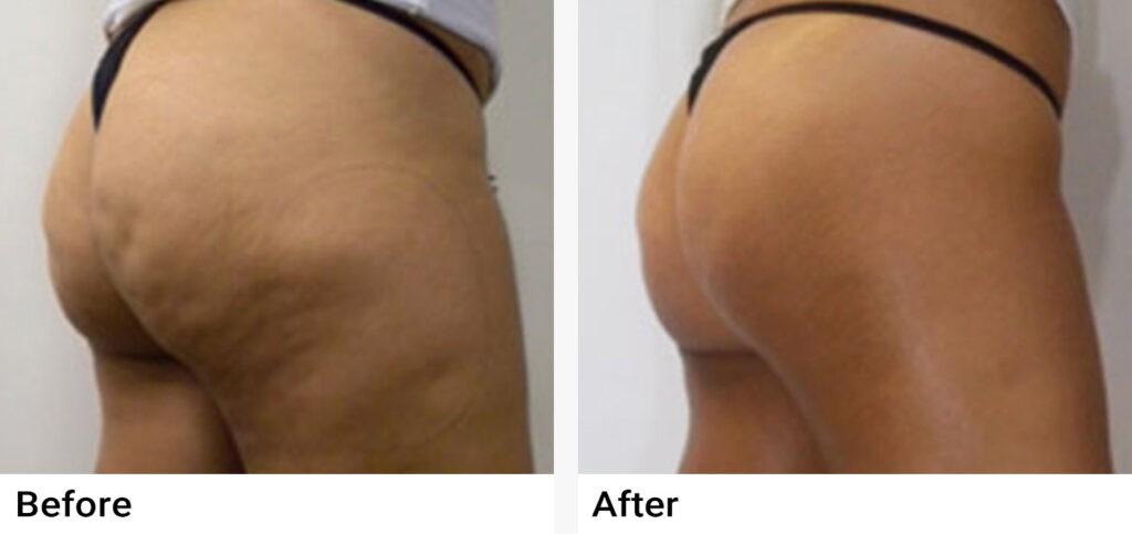 VASERShape Before & After Examples