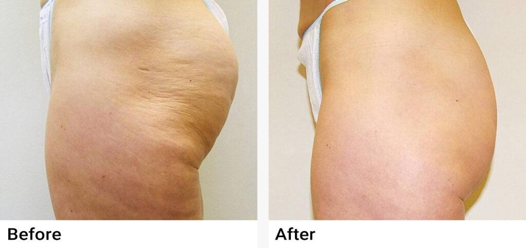 VelaShape® Before & After Examples