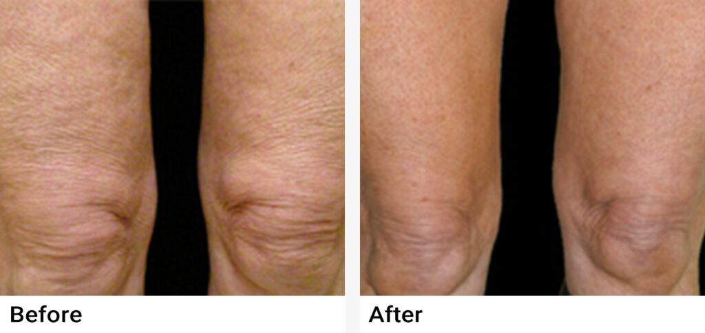 VelaShape® Before & After Examples