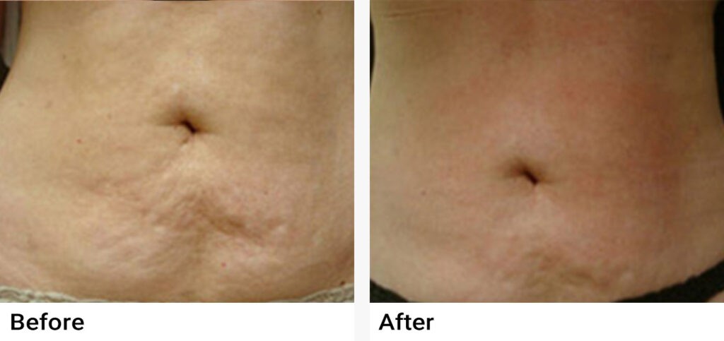 VelaShape® Before & After Examples