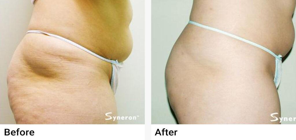 VelaShape® Before & After Examples