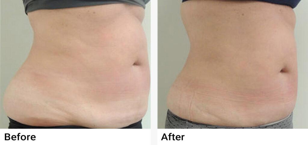 VelaShape® Before & After Examples