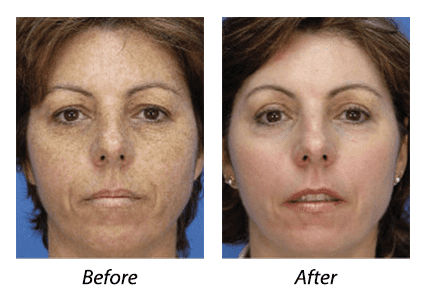 photofacial before after