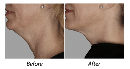 PROFOUND RF SKIN LIFT AND REJUVENATION
