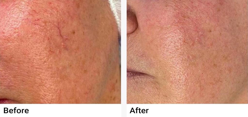 Laser Vein Removal Before & After Examples