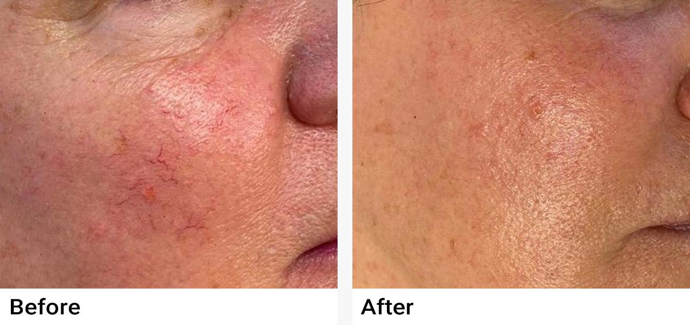 Laser Vein Removal Before & After Examples