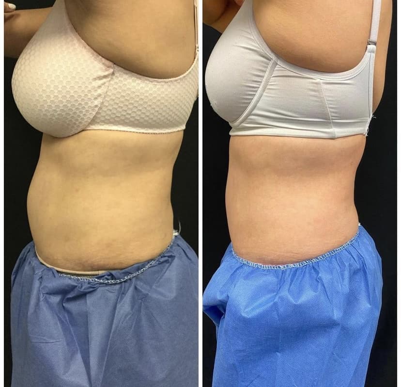 coolsculpting abdomen flanks before after results gentle aesthetics med spa braintree, ma