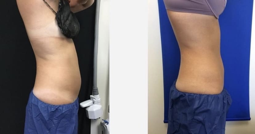 coolsculpting abdomen flanks before after results gentle aesthetics med spa braintree, ma