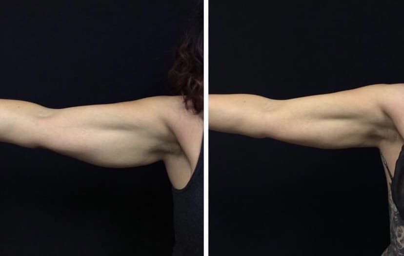 coolsculpting arm fat before after results gentle aesthetics med spa braintree, ma