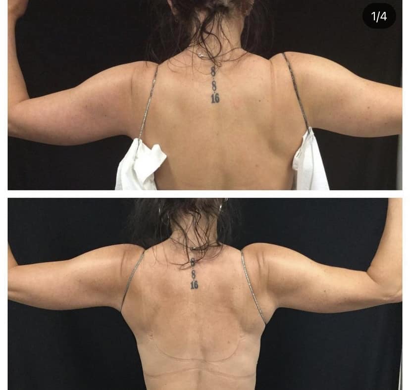 coolsculpting Bra and Back Fat before after results gentle aesthetics med spa braintree, ma