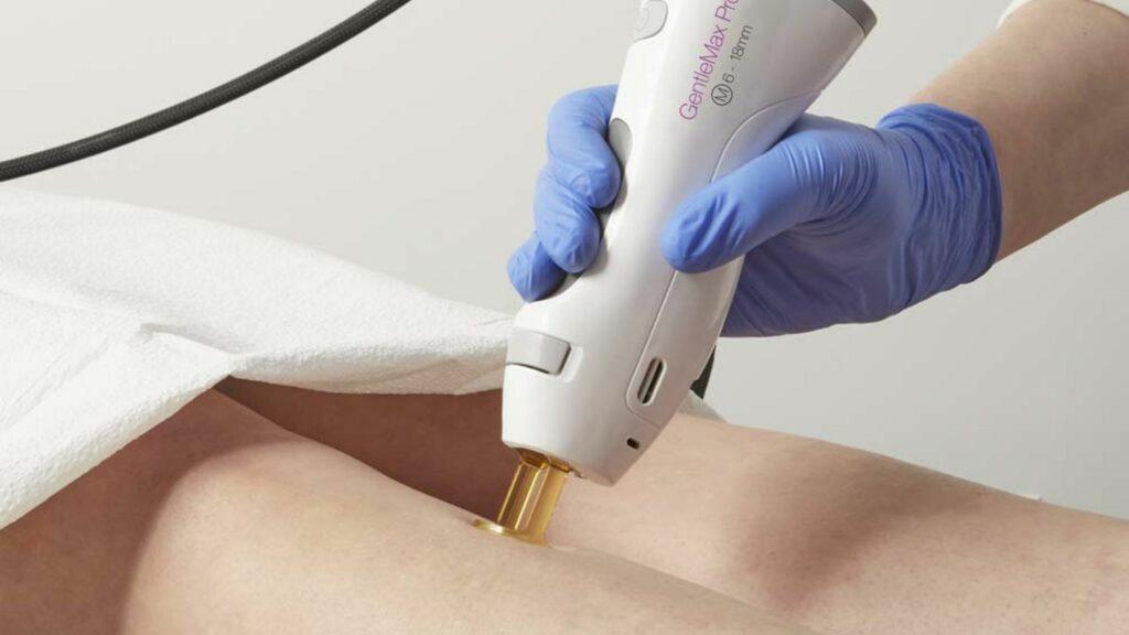 candela laser - laser hair removal braintree, ma gentle aesthetics med spa