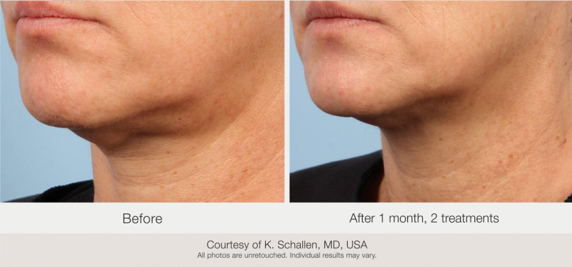Matrix Pro RF Microneedling Before & After