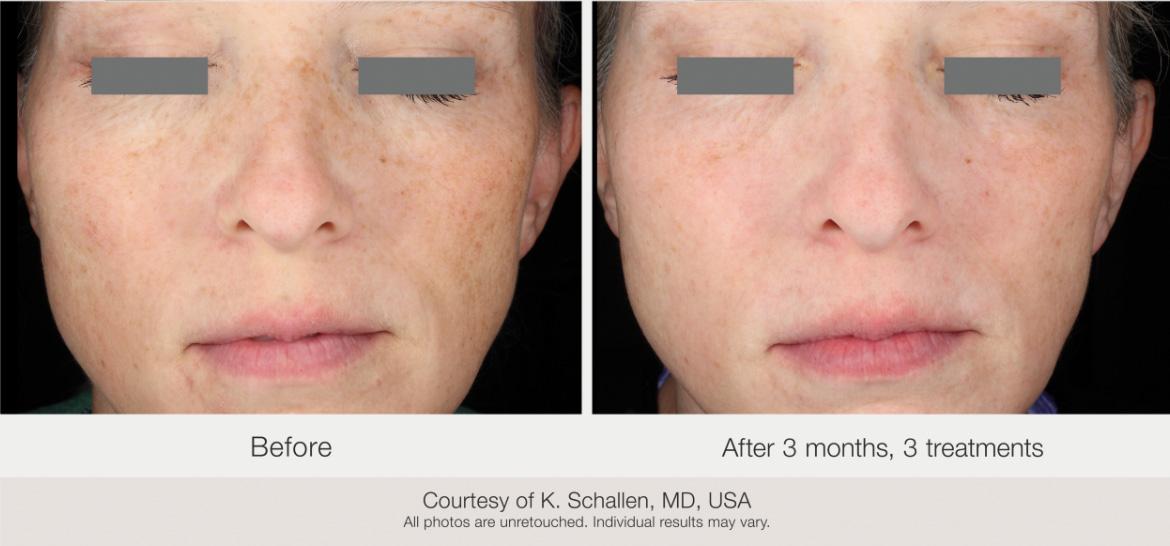 Matrix Pro RF Microneedling Before & After