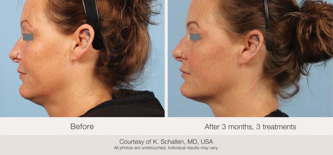 Matrix Pro RF Microneedling Before & After