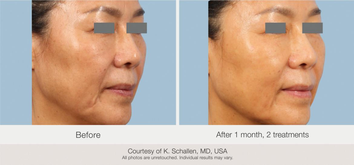 Matrix Pro RF Microneedling Before & After